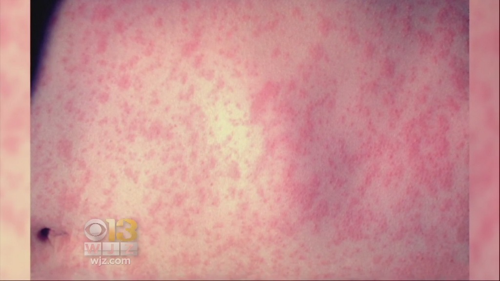 State Health Authorities Warn Of Possible Measles Exposure At Multiple Pa. Locations - CBS Pittsburgh thumbnail